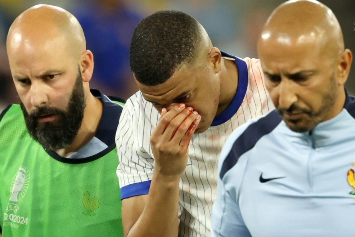 Mbappe z zlomljenim nosom, a ne bo potreboval operacije