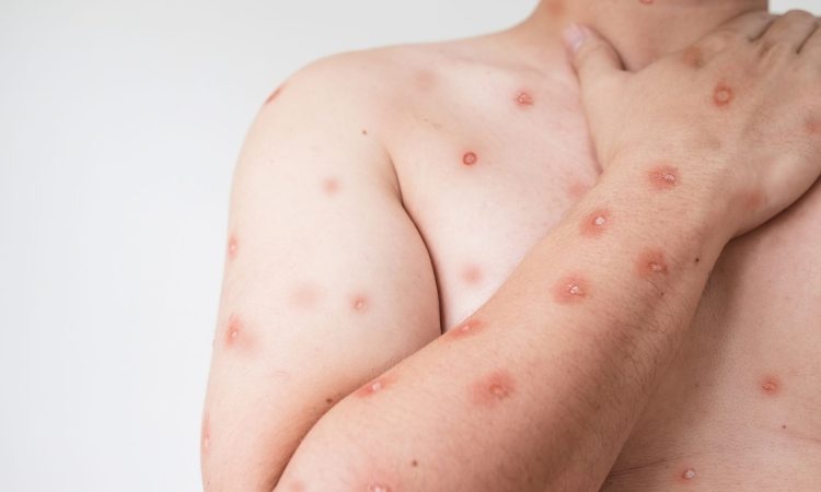 WHO odobrila prvi test za odkrivanje mpoxa