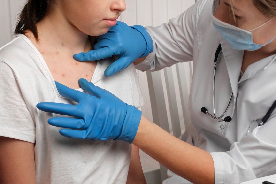 Na Otoku potrdili prvi primer okužbe z novo različico virusa mpox