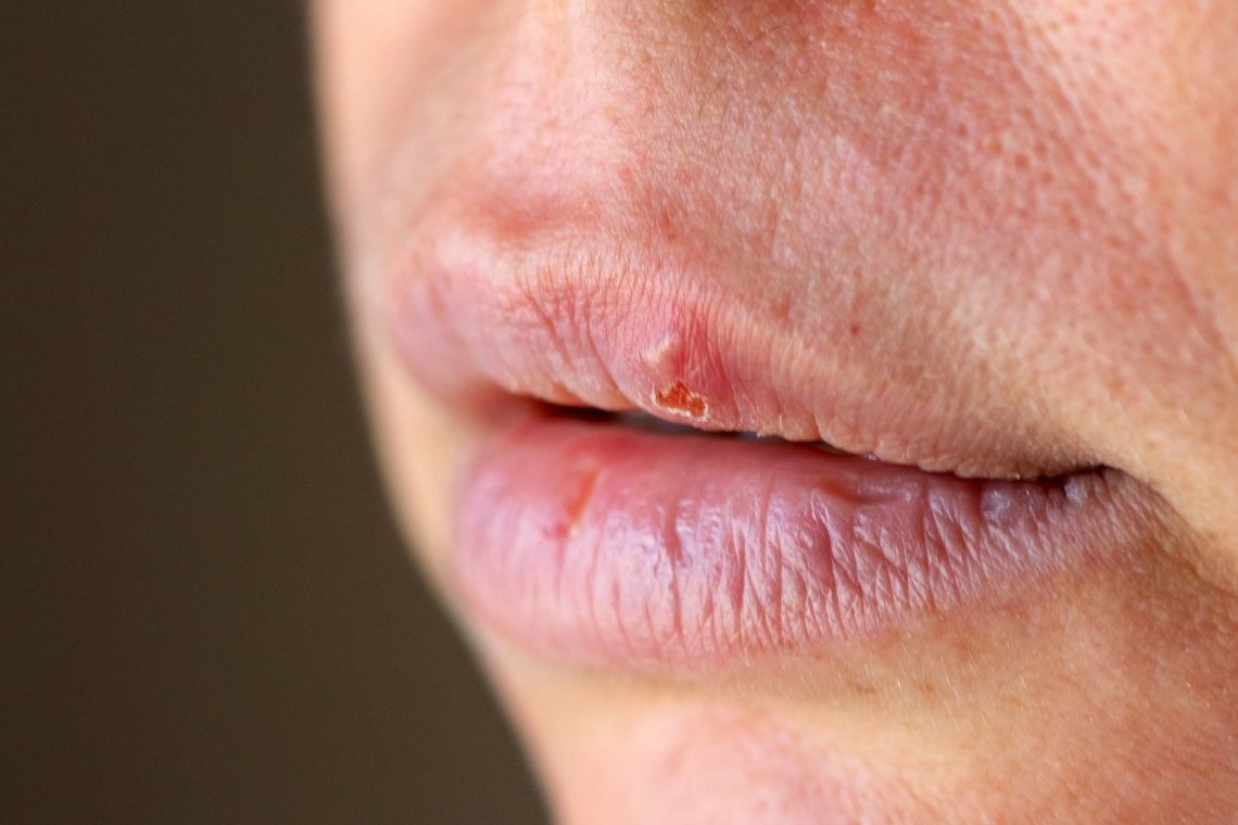 Herpes ali mozoljček: kako vedeti, kaj se je pojavilo na ustnici?