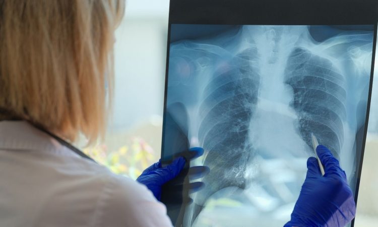 Pljučna hipertenzija pogosto ostaja predolgo nediagnosticirana
